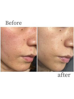 モイ(moi.)/◆漢方ハーブピーリング◆