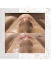 ホワイトニングショップ 広島店(WHITENING SHOP)/【ハーブピーリング】