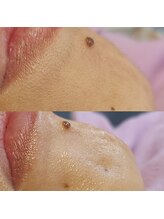 キアラ 麻布十番(Kiara)/顔ワックス脱毛のビフォーアフタ