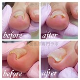 巻き爪専門ラボ 豊田店