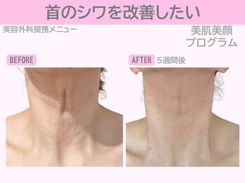 ぷるるんエステ/フェイシャル/小顔/毛穴