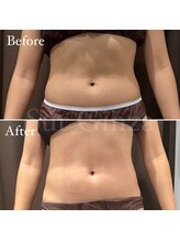 エステサロン シュール/脂肪冷却