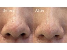 ラヴニール(L'avenir)/毛穴の黒ずみ・開きのお悩みに！