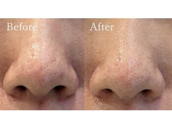 ラヴニール(L'avenir)/毛穴の黒ずみ・開きのお悩みに!