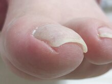 リル(relle)/巻き爪カット