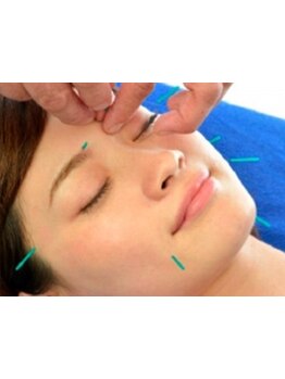 鍼灸施術を受けたい