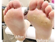 シェエスポワール(Chez Espoir)/【ケア】ガサガサ踵にさようなら