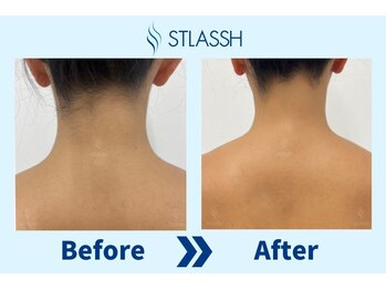 ストラッシュ 岡山店(STLASSH)/施術例：背中