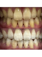 ハリス(HARIS)/セルフホワイトニング