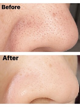 クエスト ビューティーサロン(QUEST)/ハイドロスプラッシュ