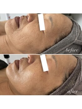 エクラ(eclat)/REVIハーブピーリング