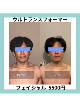 セメ(S’aimer)/ウルトラ(フェイシャル)