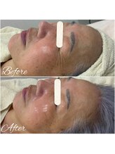 ビースキン(be-skin)/ララピールbefore→after