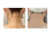 フォーティチュード(FORTITUDE)/すっきりうなじ脱毛♪