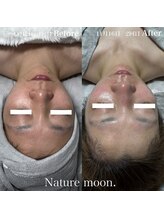 ナチュールムーン(Nature moon.)/ハーブピーリング 