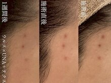 サロンヴェアリー 広尾(salon vary)/新しいニキビのあと残りにウルス
