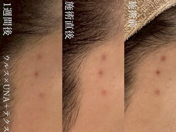 サロンヴェアリー 広尾(salon vary)/新しいニキビのあと残りにウルス