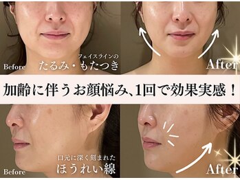 ブレア(Blair)の写真/サーマルRFでフェイスライン緩みをケア♪たるみエイジングケアで若々しい印象へ