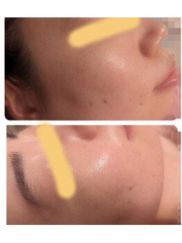 ムーンブロッサム(MoonBlossom)/肌育美肌コース