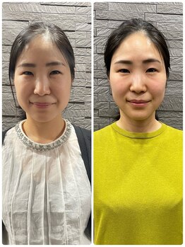 長寿鍼灸院 長寿整骨院/美容鍼50本の効果★小顔効果