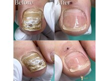 巻き爪補正店 松戸店/変形爪　肥厚爪