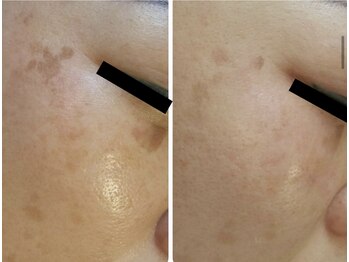 ディサイドロー(DECIDE L.A.W)/BeforeAfter