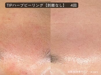 ジュパール(je pars)/TIPハーブピーリング剥離なし