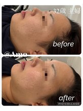 アモ(amo)/BBLフェイシャルでリフトアップ