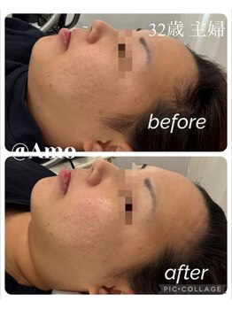 アモ(amo)/BBLフェイシャルでリフトアップ