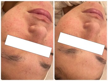 メゾンリュバン 梅田店(Maison Ruban)/ハーブピーリング｜赤み/乾燥