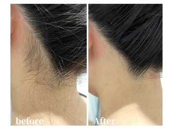 セルフメイド 石巻店/【ビフォーアフター】セルフ脱毛