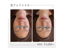 ご近所エステ 札幌店の雰囲気（光フェイシャルで脱毛効果＆シミ・毛穴などお肌悩みも改善☆）