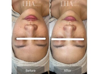 ルミナス ケア(Luminous Care)/ララピール/Before・After