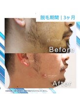 メンズクリア モラージュ佐賀店/【メンズクリア】お客様の施術例