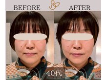 チョコバリ プラス(chocobari plus)/小顔×リフトアップ(美容)40代