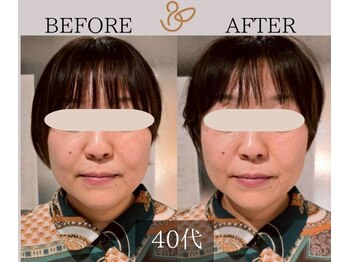 チョコバリ プラス(chocobari plus)/小顔×リフトアップ(美容)40代