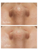 リブラン(Libran)/毛穴エクストラクション