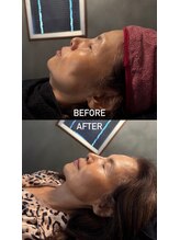 アンテグラール/日本初採用エクソソーム施術