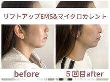 サボラミ(sabor A Mi)/EMS&マイクロカレント　5回施術
