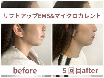 サボラミ(sabor A Mi)/EMS&マイクロカレント 5回施術