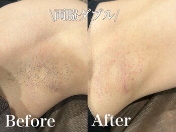 ジョエルワックス 沖縄那覇店(JOELLE WAX)/自己処理のいらないワキへ♪