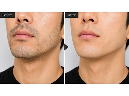 スムース ホワイトニング(SMOOOTH WAX)の写真