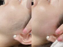 ネリネ 天神(nerine)/もみあげワックス/WAX脱毛