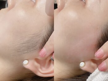 ネリネ 天神(nerine)/もみあげワックス/WAX脱毛