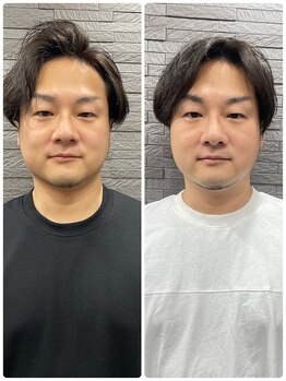 長寿鍼灸院 長寿整骨院/men's美容鍼50本効果★