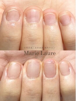 マリーロール 淀屋橋本店(Marie Laure)/自爪育成/深爪矯正/ネイルケア