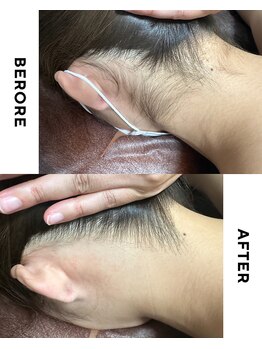 ゼロ(ZERO)/うなじ脱毛☆before&after