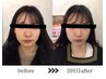 【自分史上最小顔◆人気の小顔矯正】小顔矯正¥5,000