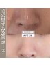 LHA成分でお鼻の徹底黒ずみ集中ケア★毛穴ツルツル小鼻へ♪