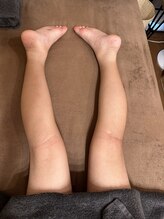 アルバ暁子鍼灸治療院(alba暁子鍼灸治療院)/小児鍼